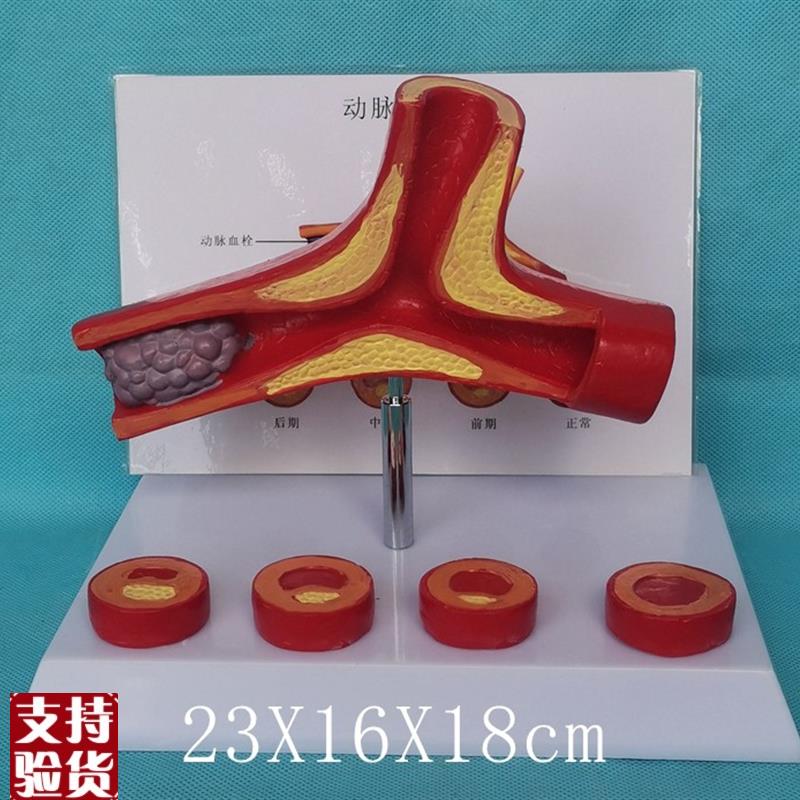 人体血管解剖模型病变血y管比较模型医用教学动脉粥样