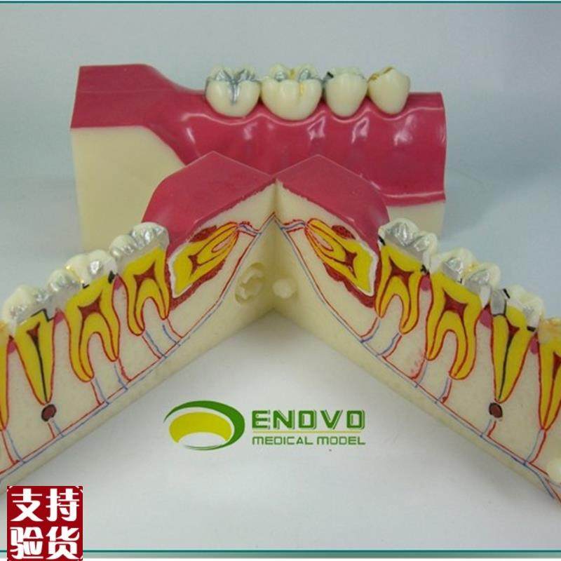 ENOVO颐诺i右下后牙组织分解模型牙齿解剖牙列模型口腔齿科科教学,文具电教/文化用品/商务用品,教学标本/模型,淘宝优惠券,粉丝福利购,淘宝优惠卷