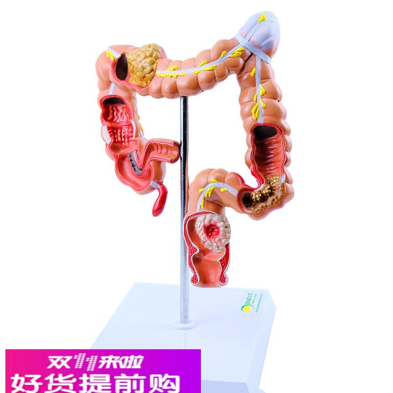 ENOVO颐诺 人体大肠疾病展示模型结肠直肠道病变症状消化系统疾病