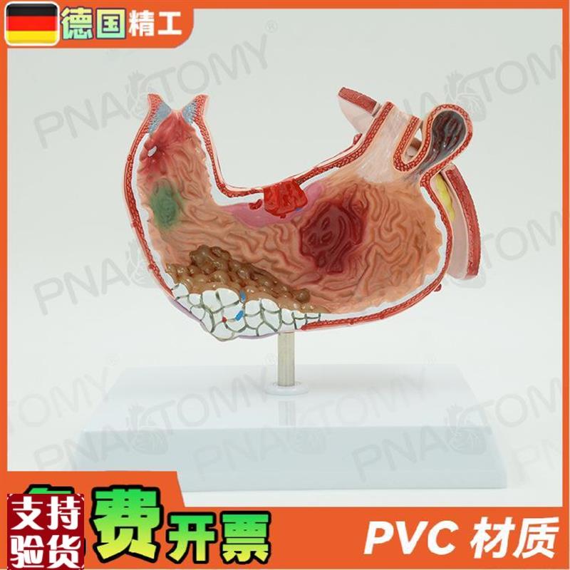 德国】人体胃结构消化o系统解剖模型病理展示标本医学内脏器官消