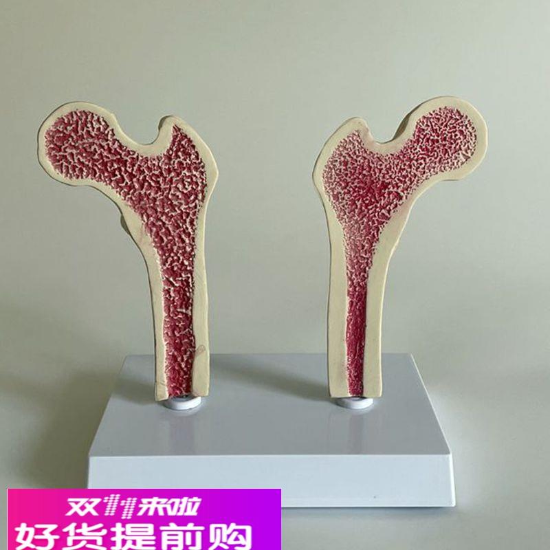 骨质疏松模型股骨头骨髓密度变化骨科医药促销年龄段脊椎病理医患