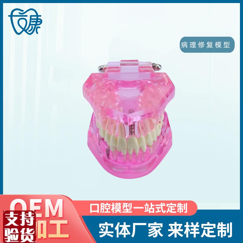 牙齿模型病理修复可拆卸s正畸口腔病理牙模型牙科医患活动沟通