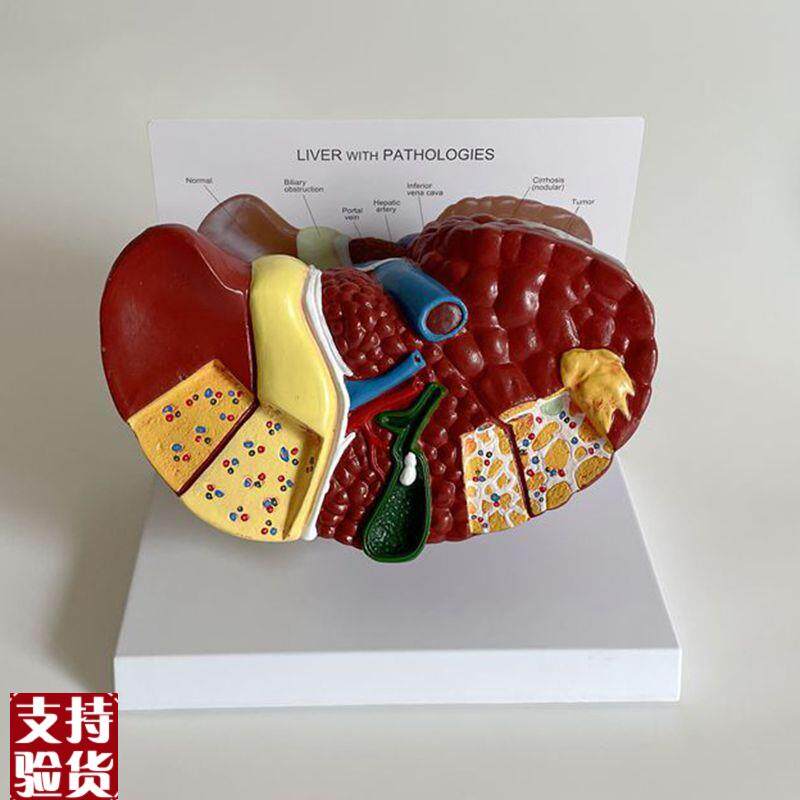 康泰模型肝脏脂肪肝叶韧带门静脉胆囊肝总管病理S酒精消化道医药