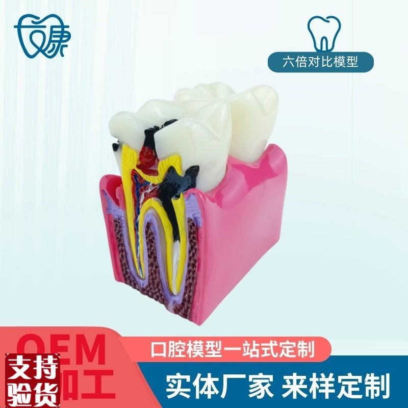 6倍对比模型牙科教学器材6倍y龋齿对比模型口腔模型教学牙齿模型
