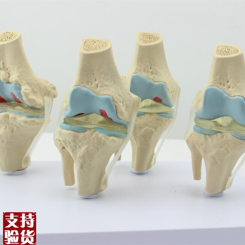 ENOVO颐诺人体病理p膝关节模型退行性血友病模型骨科管骨骼模型膝