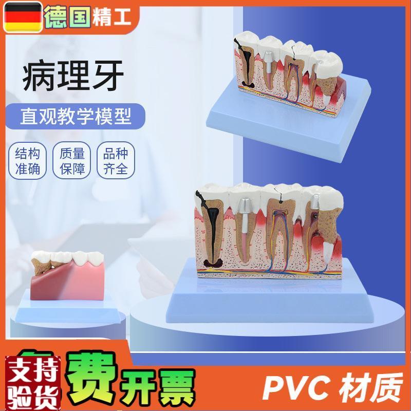 德国牙齿牙科病理学医学教学沟通模型解剖放大病理演示Z牙科模型