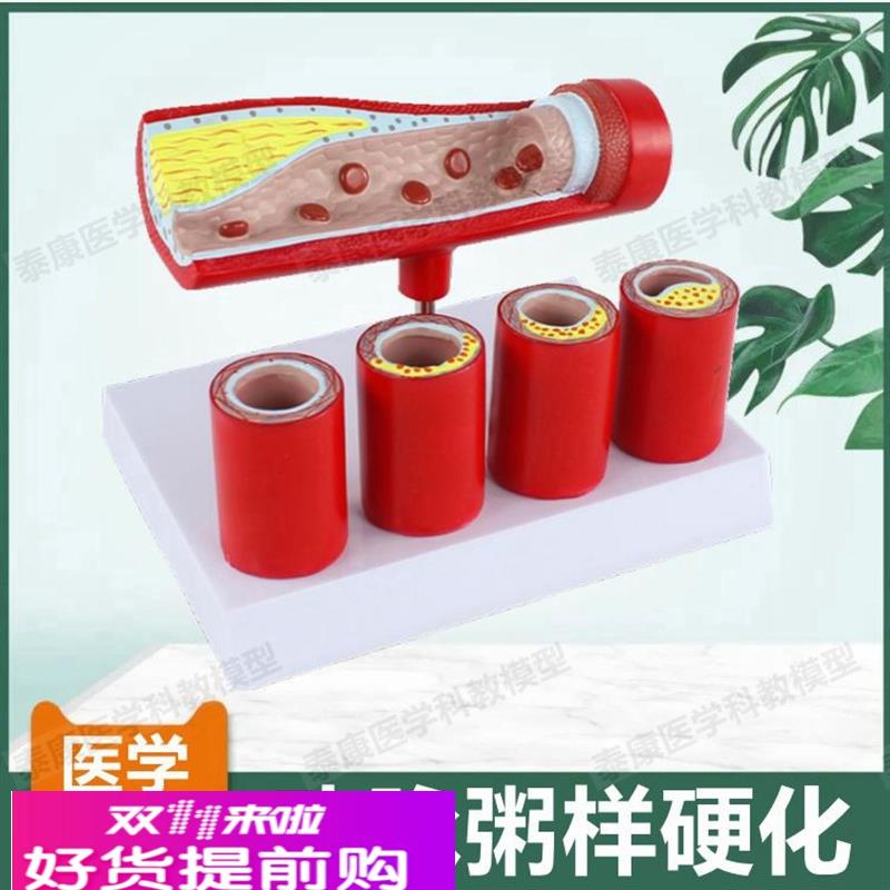 动脉血管模型内膜粥样斑块阻塞狭窄硬化医患药礼品血管壁层次解剖