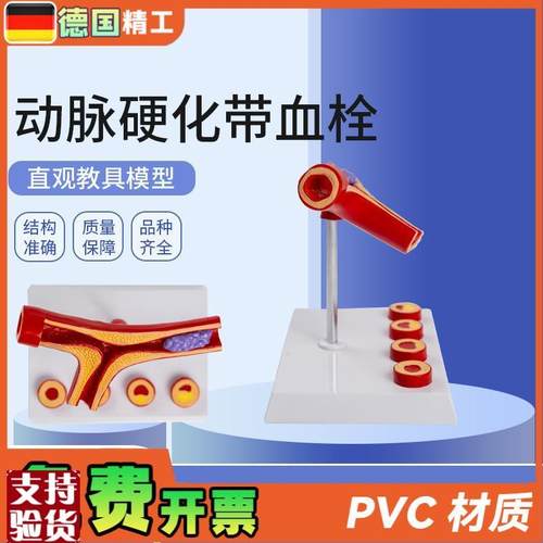 德国】动脉d带血栓模型5部件血管堵4塞血管粥样血管病理解剖