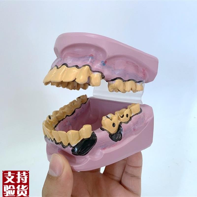 人体牙齿模型病变牙牙病理吸烟z牙烟民牙牙齿解剖口腔牙牙齿放大
