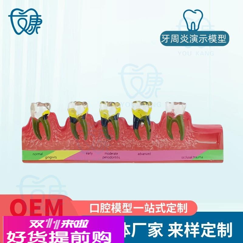 牙科口腔教学模型 牙周炎模型 牙周炎演变模型 牙科口腔教具