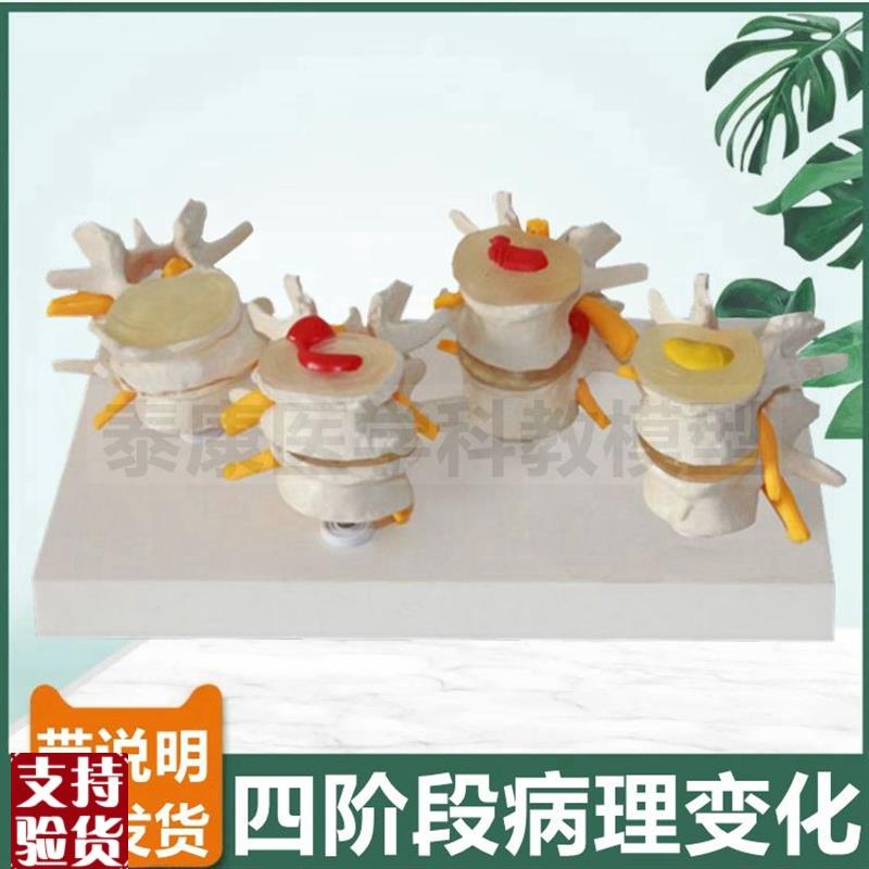 腰椎模型骨质变化椎间盘劳损突出病理不同年龄段脊椎医.患医药礼