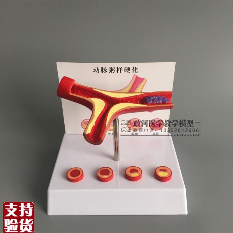冠状动脉性心血管动脉硬化模型老L年心脏模型血栓形成