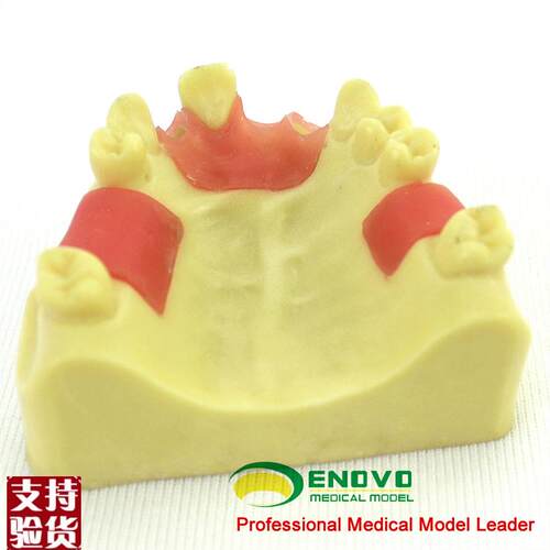 ENOVO正品牙医口腔种植培训上颌骨缺失牙齿科Q种植体操作练习模型