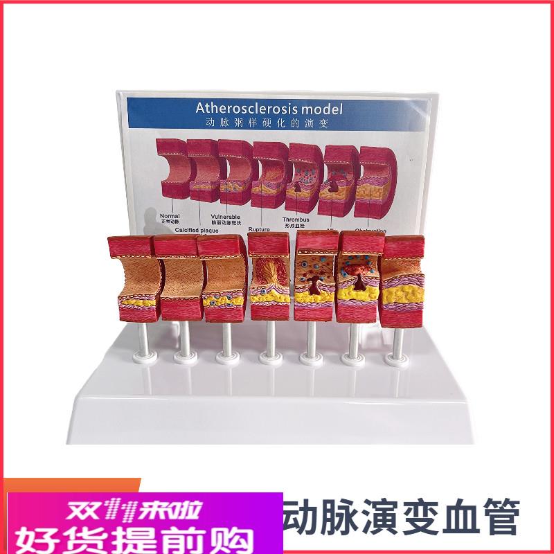 动脉粥样硬化模型血管血栓栓塞模型动脉血管人体医用医学教学教仪