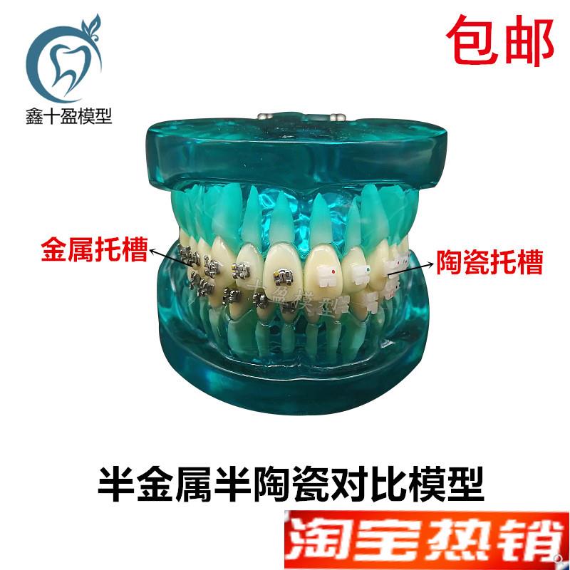 牙科正畸牙模带金属陶瓷托槽牙模型F医患沟通教学口腔牙模型包邮