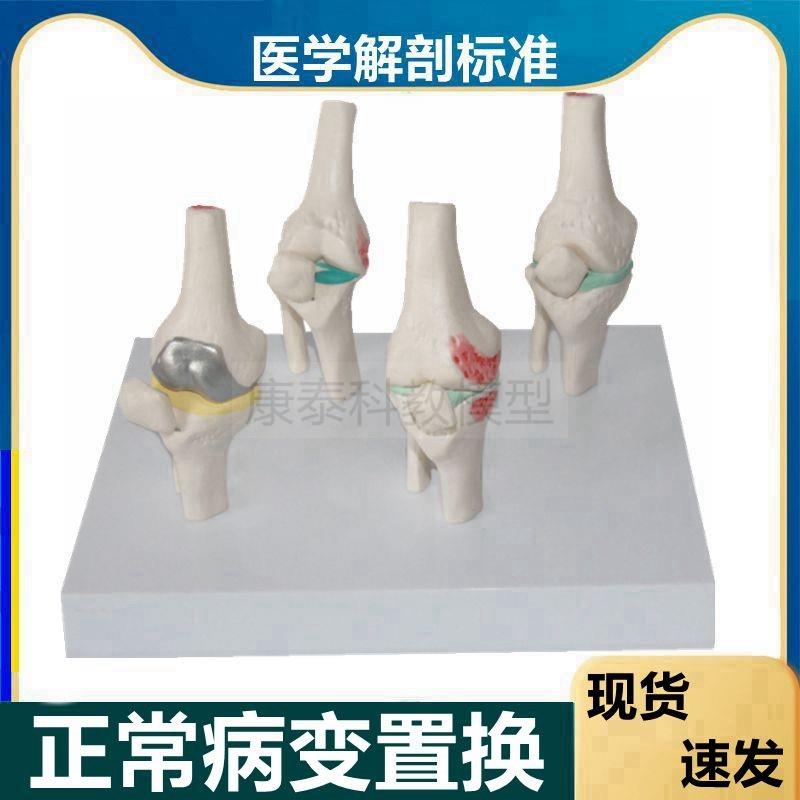 膝关节模型软骨更换骨赘半月板受损毛刺磨损交叉韧带膝.盖病理医