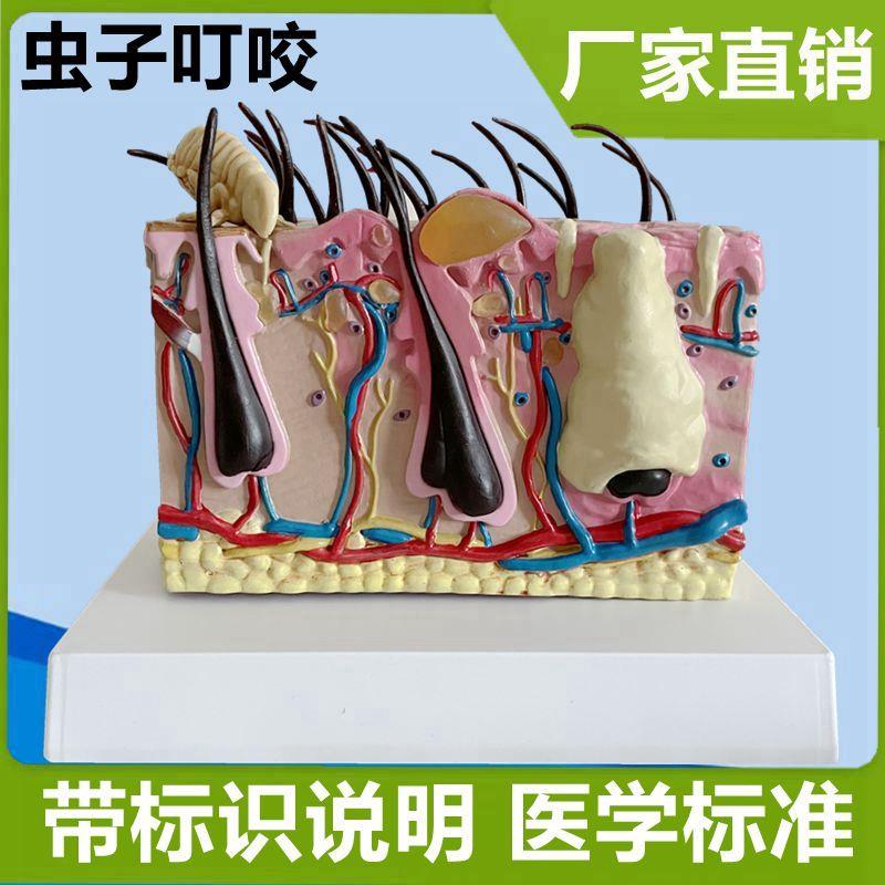 病理皮肤模型螨虫叮咬皮肤毛发毛A囊皮下病变皮肤美容医美礼品医