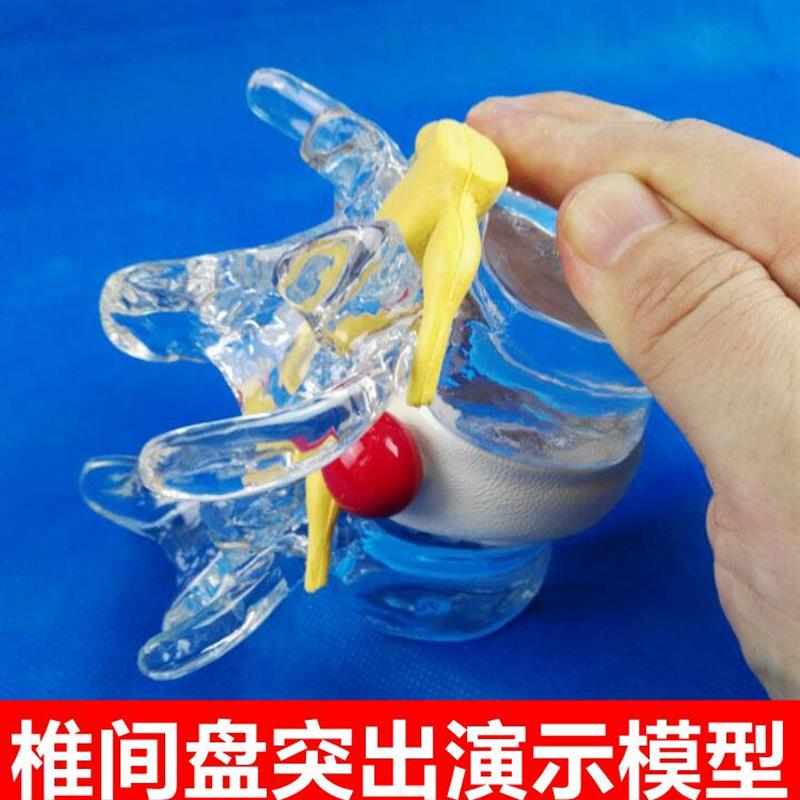腰椎间盘受压突出演示模型压迫神经脊椎骨劳损P2节腰椎可拆卸病理