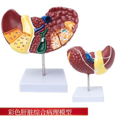 彩色肝脏模型常见临床病理特征医C生用医患沟通硬化脂肪炎肝胆内