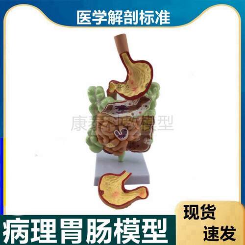 消化系统模型f食管胃肠道病理穿孔医药礼品医患沟通内镜常见粘膜