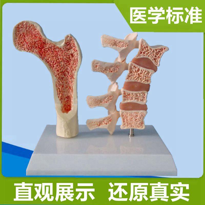 股骨模型股骨头骨密质松质骨髓腔D病理骨质医患医学教育医药器材