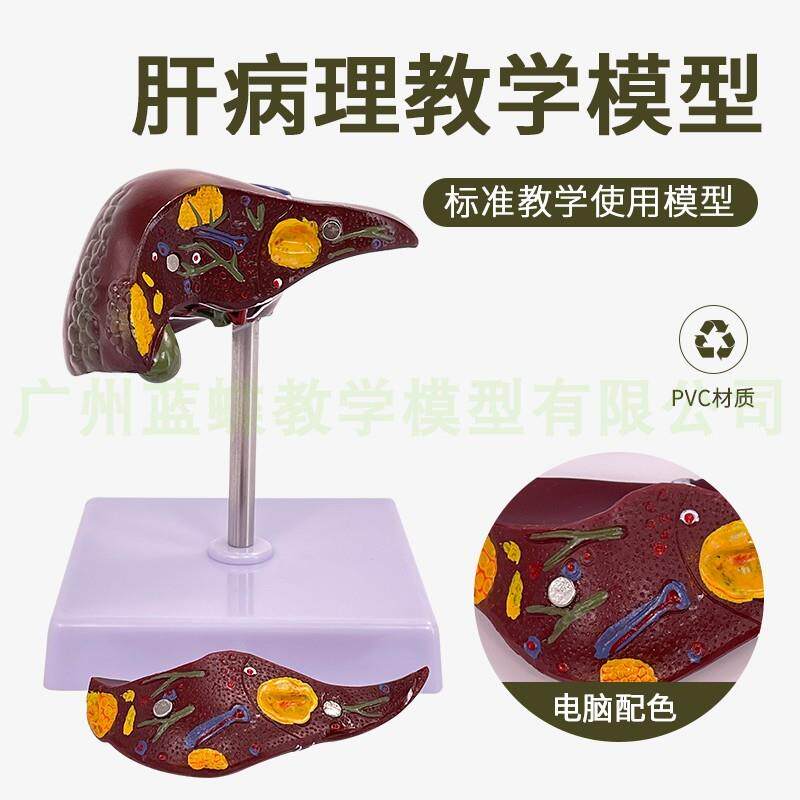 肝脏病理模型脂肪模型肝胆模型病变肝仿真人体W肝脏解剖模型