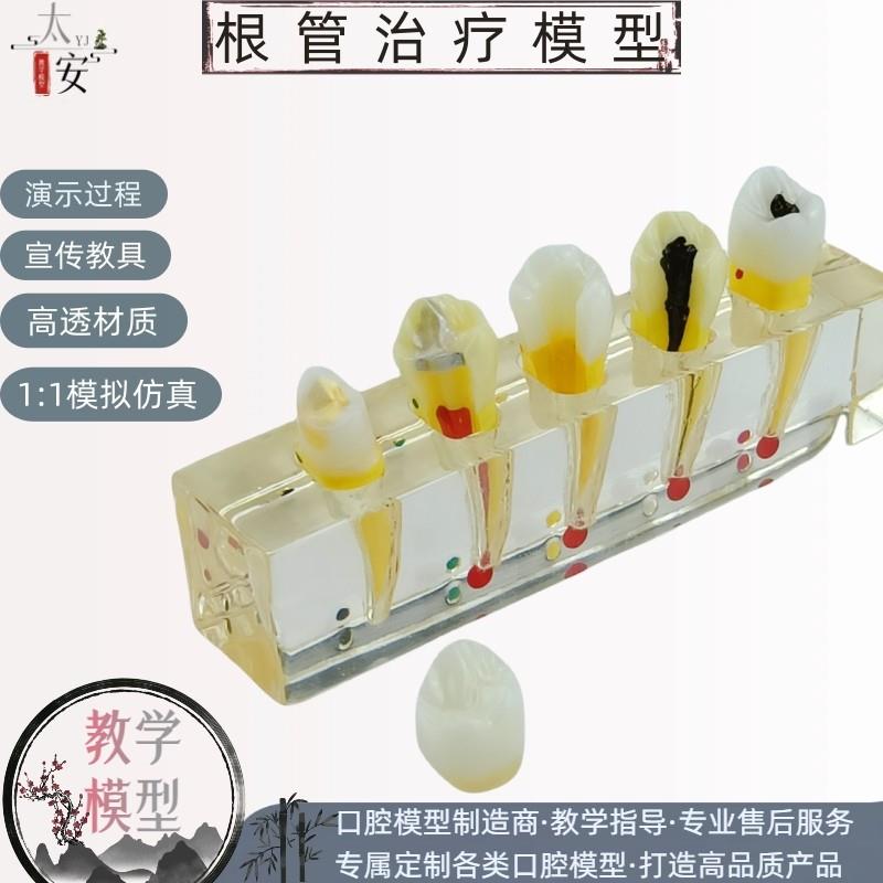根管治疗模型牙科l模型牙齿模型牙科口腔模型医患沟通演示教具