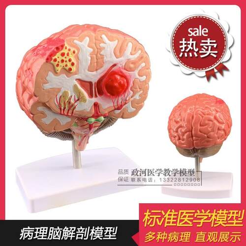 仿真人体脑部疾病模型大脑解剖神经内外科脑病理大Z脑病变模型