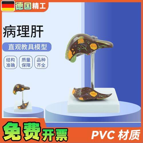 德国】肝脏病理病理肝模型D结石胆模型肝演示病理胆囊