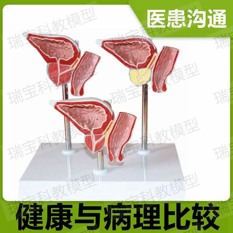 前列腺模型健康病理比较中老年人前列H腺变化医患教具男生殖器解