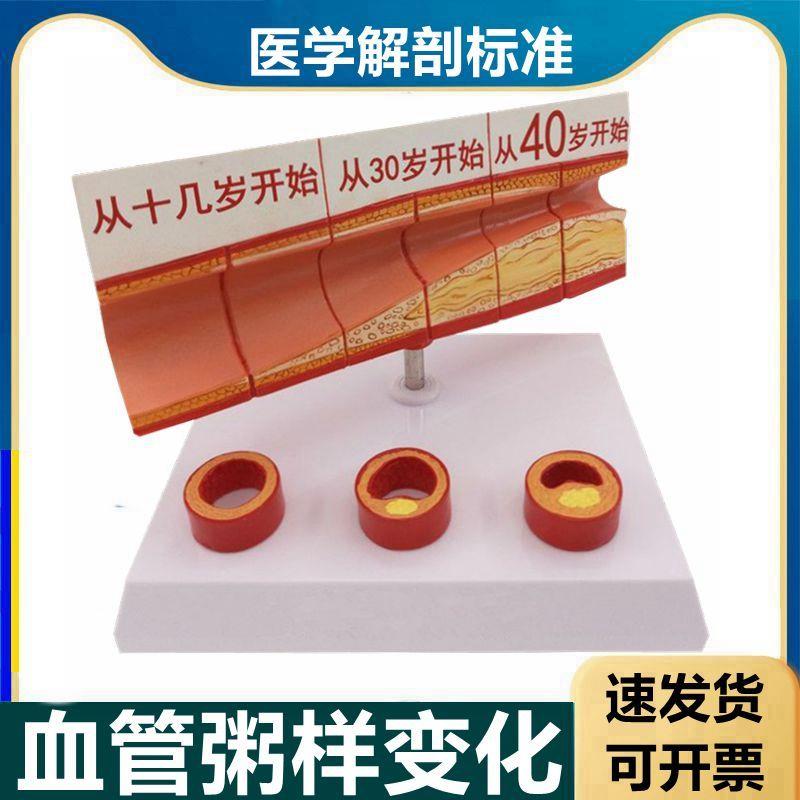 动脉血管模型不同年龄段血管内膜变化粥样硬P化栓子血管狭窄斑块