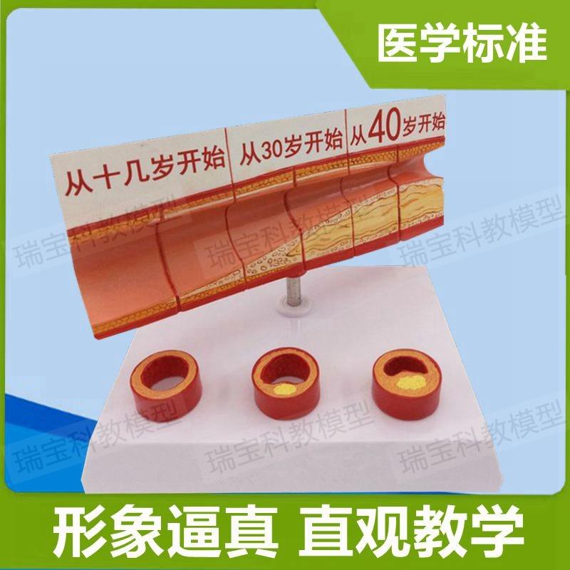 人体血管模型随年龄变化狭窄阻塞粥样演变心脏冠T状动脉医患沟通