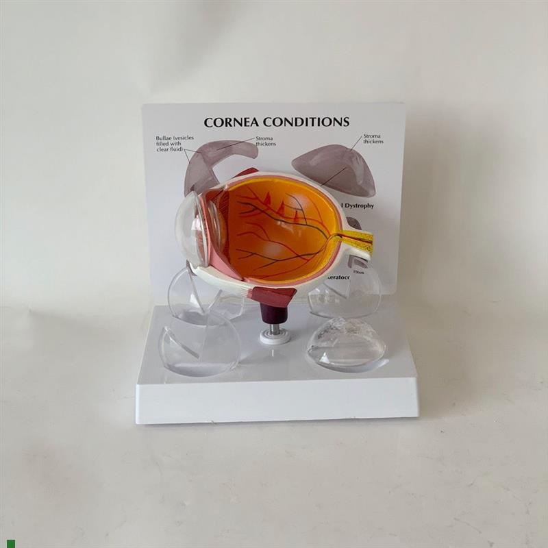 角膜模型视力感觉器m官白内障青光眼视网膜眼底眼科教学医患医药