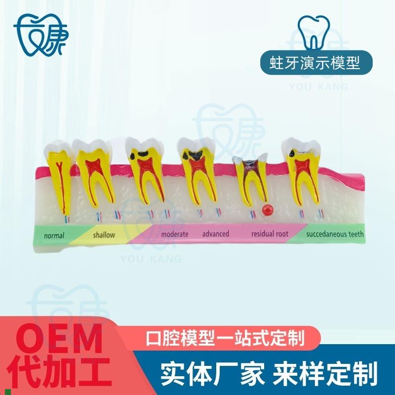 口腔教学模型牙科口腔牙科蛀A牙模型蛀牙演示模型蛀牙龋齿模型