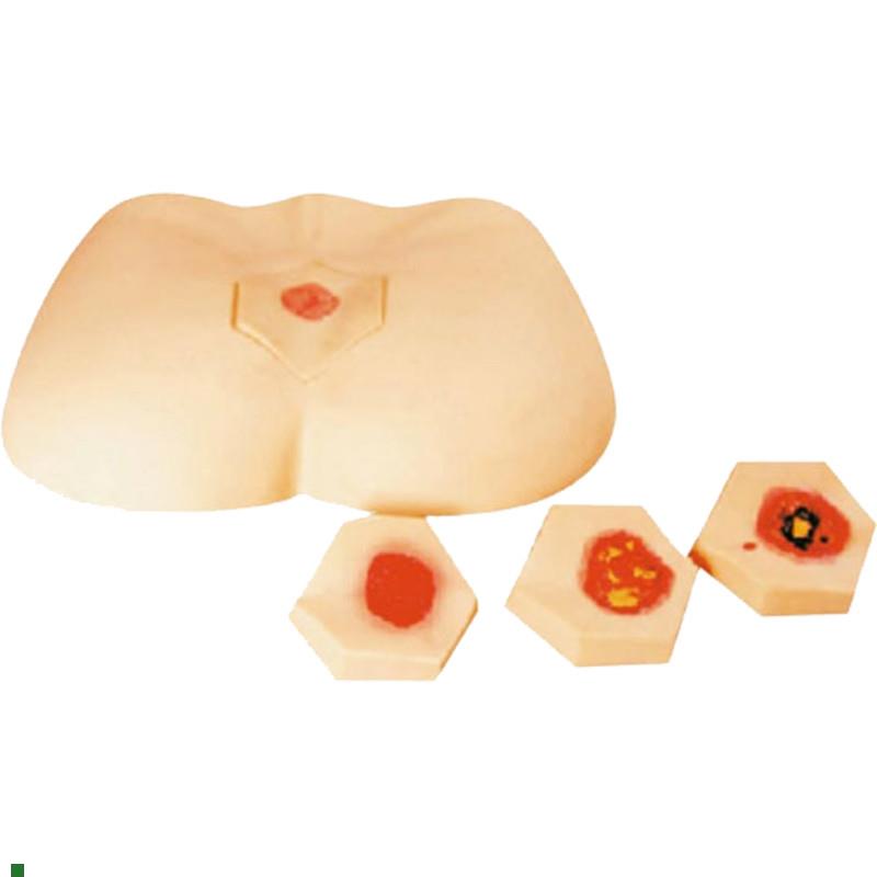 阶段褥疮护理模型H9T0F护理模型