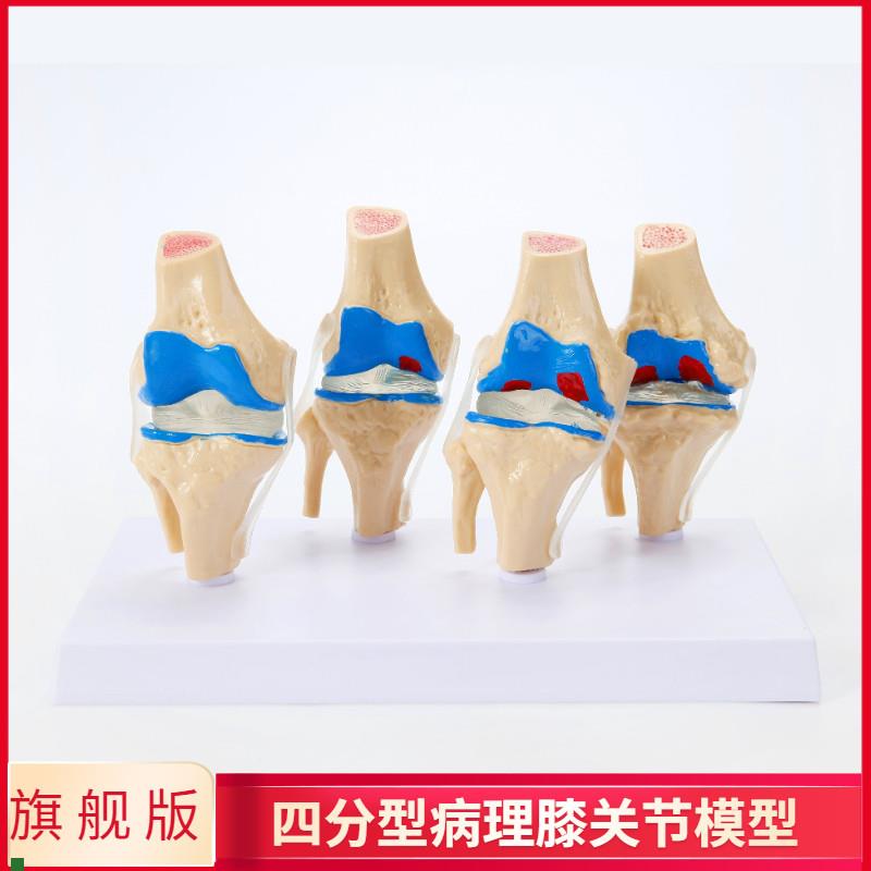 膝关节模型病变膝j关节模型骨科教学展示膝盖骨质曾生病理人体关