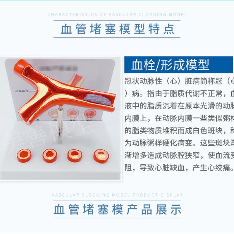 血管堵塞动支脉粥样硬化心血管模型堵塞程O度变化病理血管模型