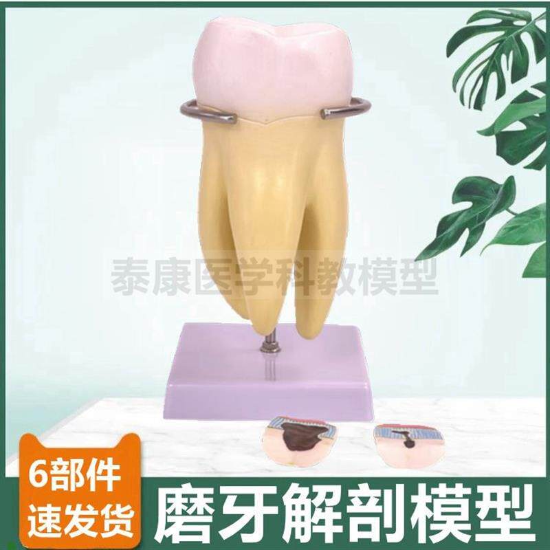 牙齿模型切d牙尖牙磨牙拆卸口腔牙医牙科教学标本龋齿蛀牙发展过