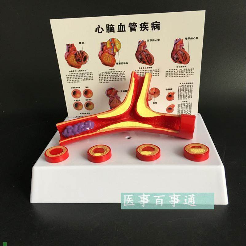血管模型冠状动脉性心脏病动脉化模型老年科医患沟Y通演示模型