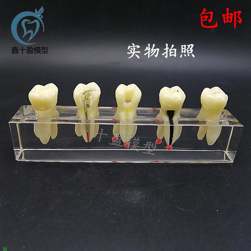 口腔教学模具f水晶根管治疗模型可拆修复牙冠龋齿蛀牙病理M4012