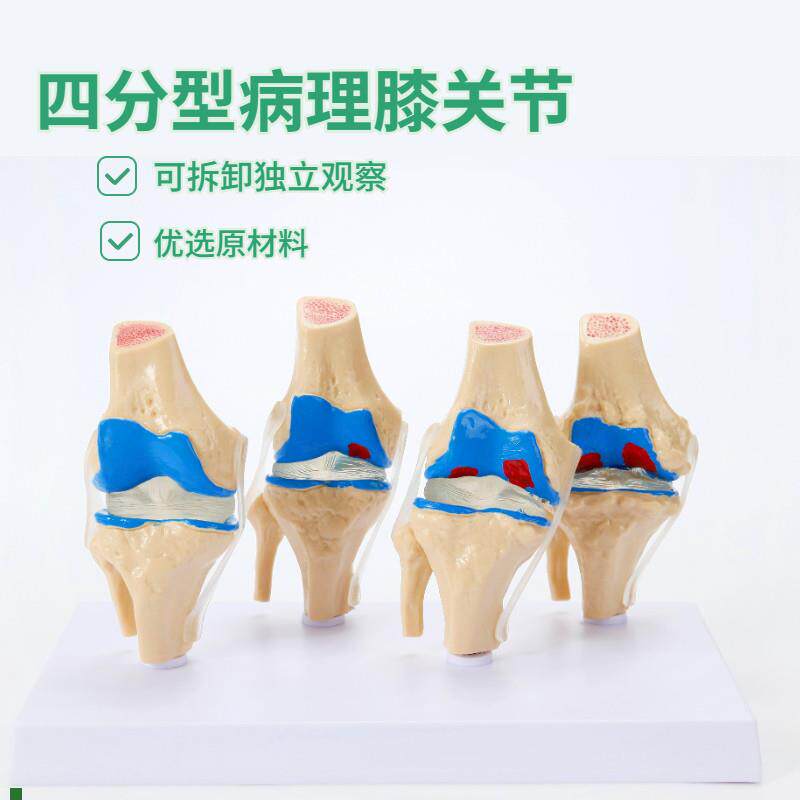 人体病理膝关节模型病q变四分型膝关节退行性膝关节关节镜手术沟