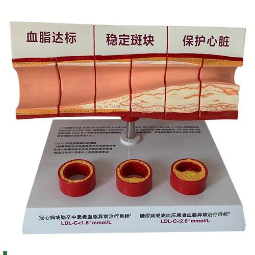 人体血管斑块狭窄粥样硬化心血管动脉硬化模型X血栓人体教学
