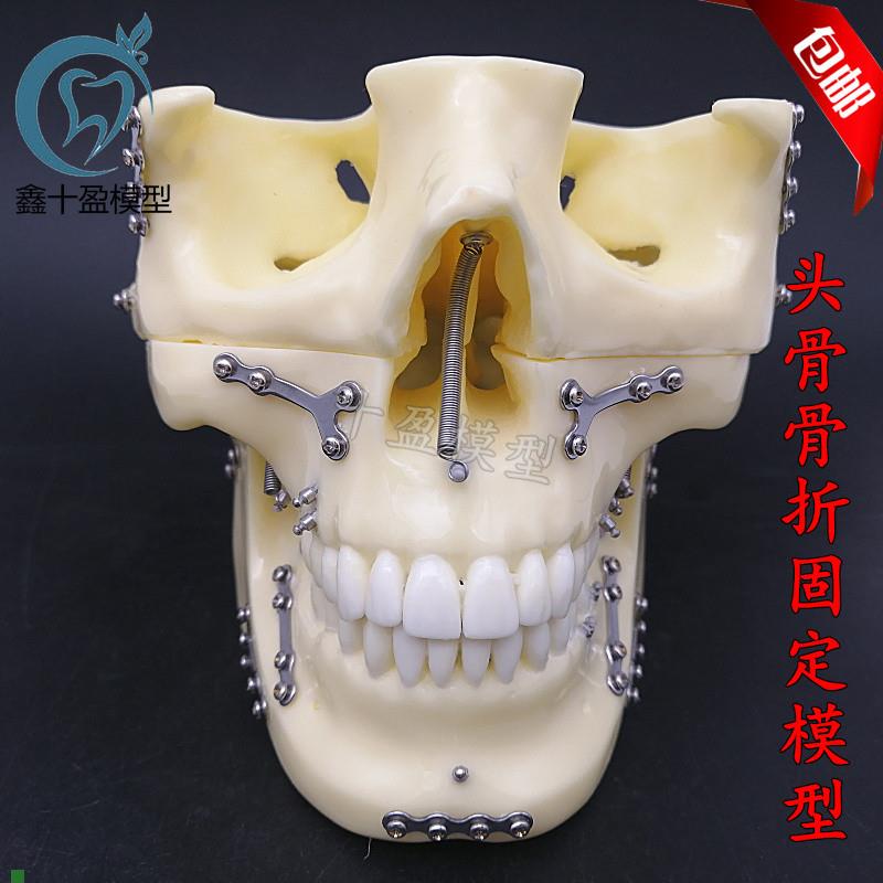 牙科种植支抗钉模型头颅骨折固定模型I头颅骨口腔模型医学教学