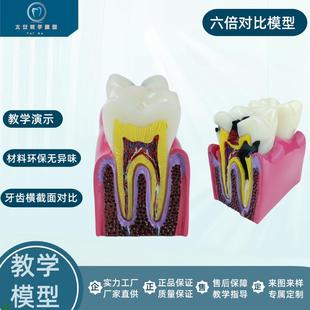 牙科口腔模型解剖放大蛀牙模具医患沟通六P倍牙齿龋坏病理演示