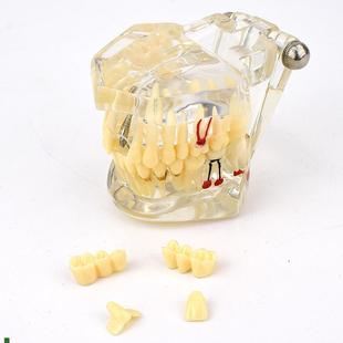 ENOVO颐诺口腔模型齿科种y植阻生齿牙体牙髓口腔教学马里兰桥瓷贴