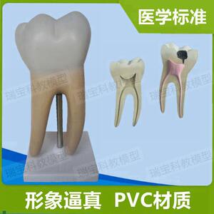 大型磨牙b模型可拆卸牙根牙髓腔蛀牙口腔健科普牙科医生教学器材