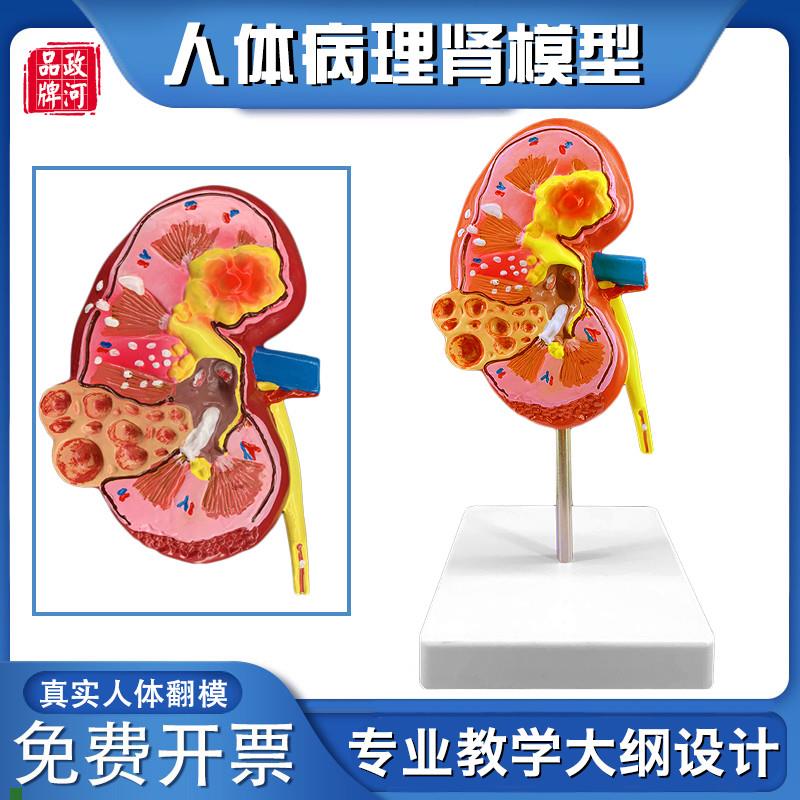 政河病理肾人体器官结构解剖模z型医院内脏科肾脏摆件学校教学演