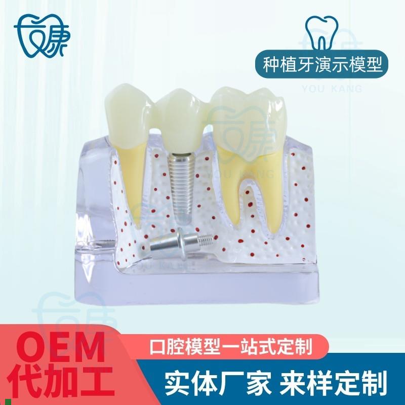 适配牙科种植牙模型模拟仿真口腔教学模型种植牙可拆卸牙齿厂家直
