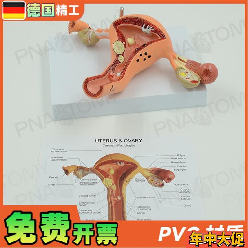 德国】女性子宫卵l巢病理病变模型生殖科妇产科教学计生医学教学