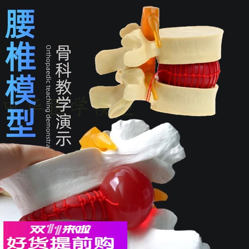 人体脊椎骨头腰椎间盘模具脊柱模型椎体模型突出受压病理骨质教具